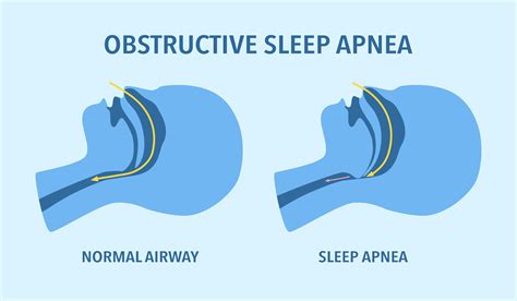 sleep apnea po polsku|SLEEP APNOEA .